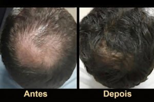 Recuperação capilar na coroa: resultado parcial após 9 meses