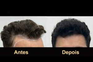 Transplante + tratamento