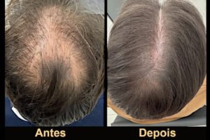Recuperação de volume e densidade capilar