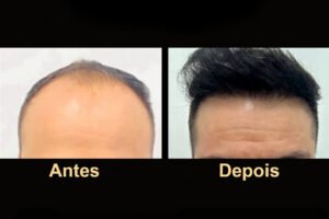Transplante + acompanhamento clínico