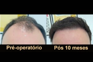 Evolução capilar