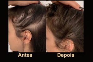 Tratamento de queda pós "caneta emagrecedora"