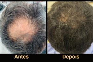 Transplante com body hair