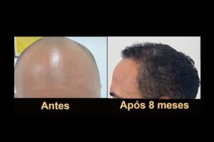Rejuvenescimento da aparência após transplante capilar