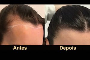 Restauração de linha frontal feminina